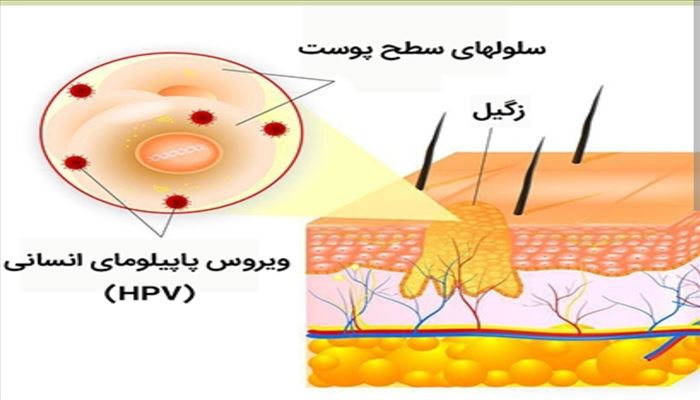 زگیل تناسلی 