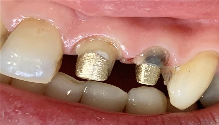 مراحل و مدت زمان ساخت روکش دندانی