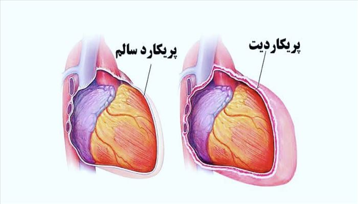 پریکاردیت یه التهاب پریکارد