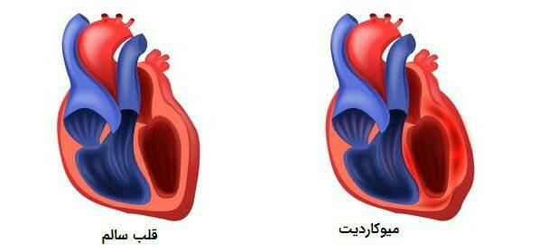 آیا عضله قلب عفونت می کند؟؟