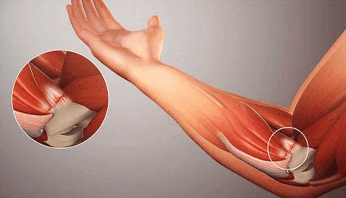 انواع آسیب دیدگی در تمرین
