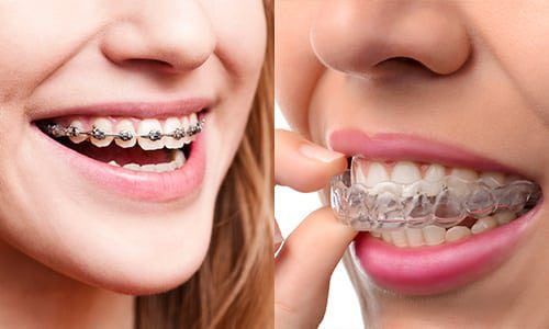 ارتودنسی با الاینر شفاف یا ارتودنسی ثابت؟ 