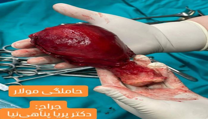 حاملگی مولار حاملگی مولار