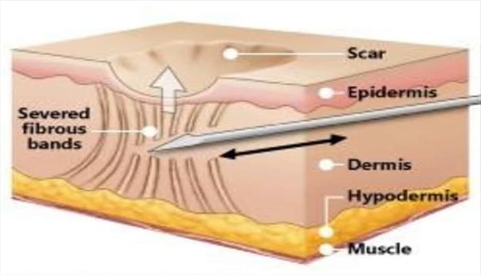 سابسیژن (Subcision)